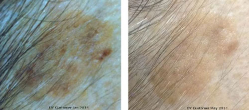 Actinic Keratosis Healed with Copper Peptides